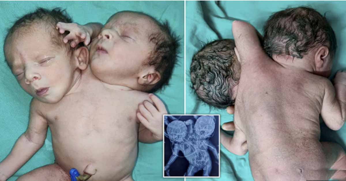 Baby born with two heads